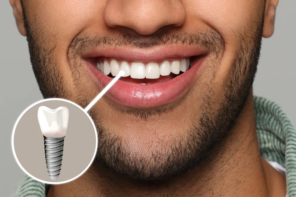 All-on-4 dental implant full-arch restoration at Indian Trace Dental