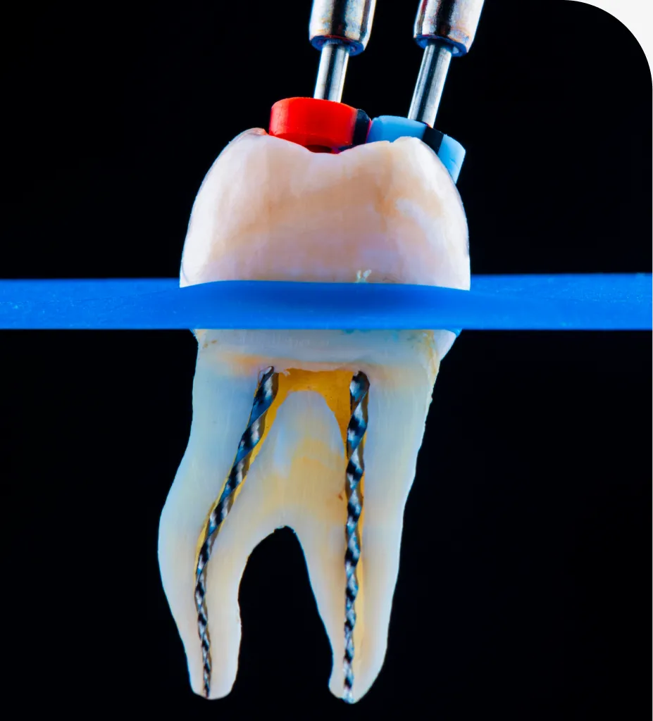 Comfortable root canal therapy at Indian Trace Dental